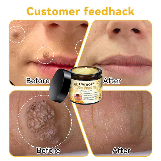 ✅2024 Google Trusted Store - Hypethetic Pharmacy| Cvreoz® Bee Venom Skin Treatment Cream