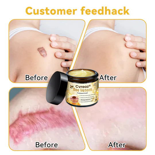 ✅2024 Google Trusted Store - Hypethetic Pharmacy| Cvreoz® Bee Venom Skin Treatment Cream