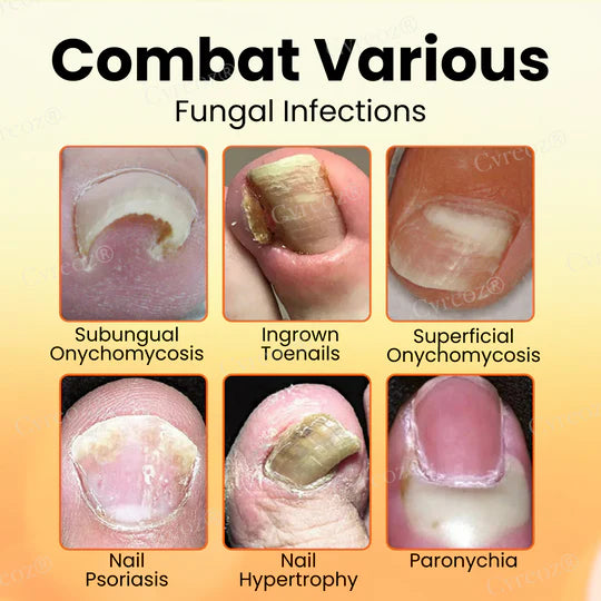 ✅Official Store - Walgreen Pharmacy| Cvreoz® Bee Venom Nail Fungus Treatment Cream