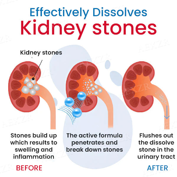 Heafied™ Kidney Stone Treatment Cream