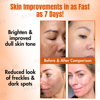 ✅Official Store - Walgreen Pharmacy| Skinetiv™ TripleAction Vitamin C Freckle Removal Cream