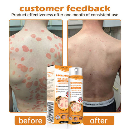 ✅Official Store - Hypethetic Pharmacy| AEXZR™ PsoriaHeal Bee Venom Psoriasis Treatment Spray