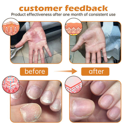 ✅Official Store - Hypethetic Pharmacy| AEXZR™ PsoriaHeal Bee Venom Psoriasis Treatment Spray