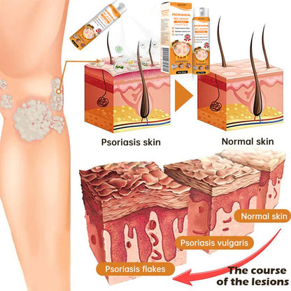 ✅Official Store - Hypethetic Pharmacy| AEXZR™ PsoriaHeal Bee Venom Psoriasis Treatment Spray