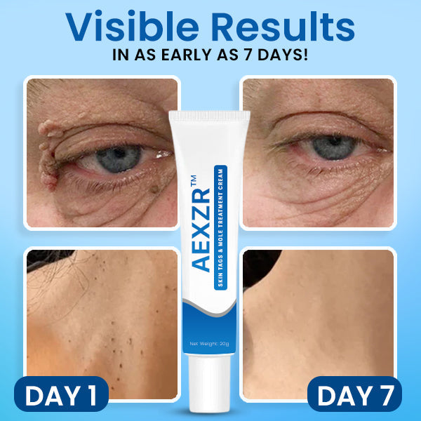 AEXZR™ Skin Tags & Mole Treatment Cream