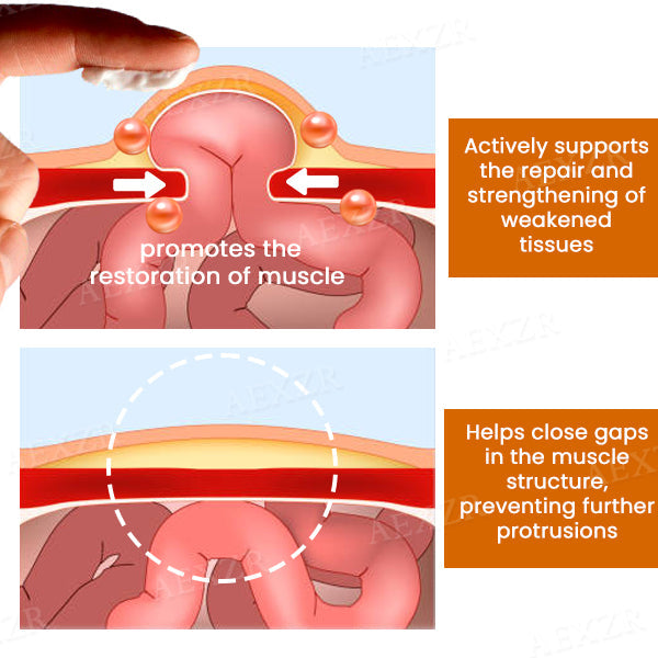 Enzyil™ Hernia Treatment Cream