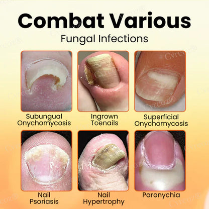 ✅Official Store - Walgreen Pharmacy| Cvreoz® Bee Venom Nail Fungus Treatment Cream