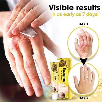 ✅Official Store - Walgreen Pharmacy| AEXZR™ Eczema Cure Cream